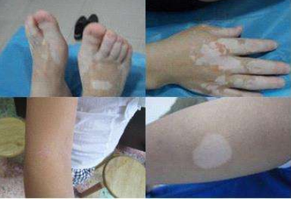 合肥华夏白癜风医院