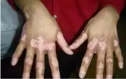 合肥华夏白癜风医院