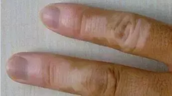 合肥华夏白癜风医院