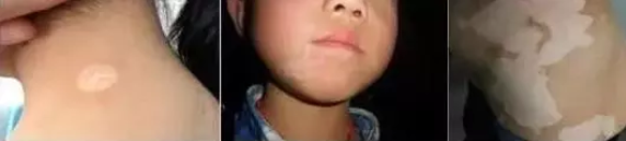 合肥华夏白癜风医院