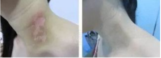 合肥华夏白癜风医院