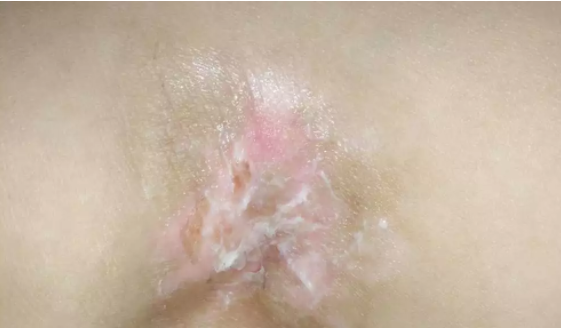 合肥华夏白癜风医院