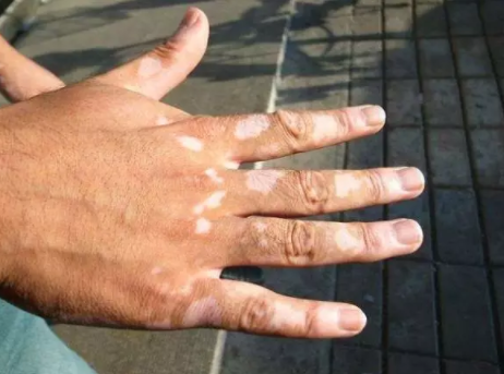 合肥华夏白癜风医院