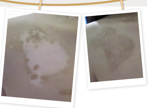 合肥华夏白癜风医院