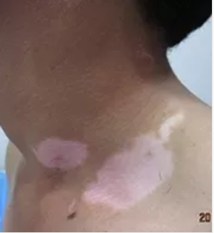 合肥华夏白癜风医院