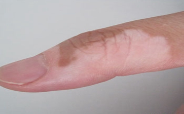 合肥白癜风医院